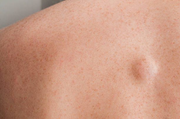 Small lipoma on the back of caucasian man