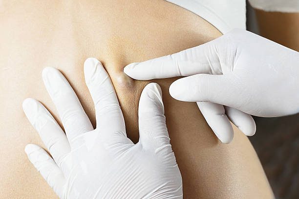 Врач диагностирует кожные выделения на спине у женщины